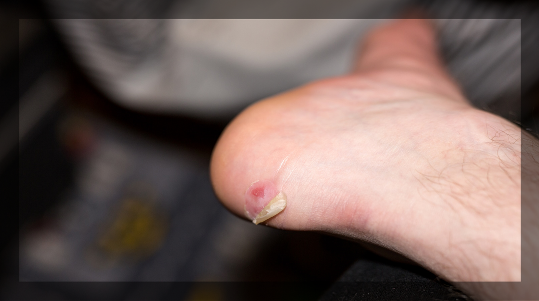 Guide to Blister Free Hiking